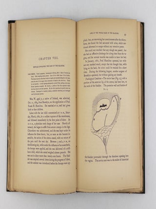 VESICO-VAGINAL FISTULA FROM PARTURATION AND OTHER CAUSES: WITH CASES OF RECTO-VAGINAL FISTULA [Signed]