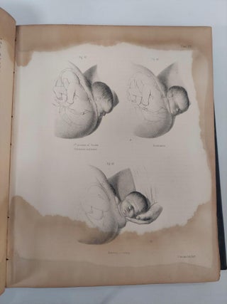 THE PRINCIPLES AND PRACTICE OF OBSTETRICS. ILLUSTRATED WITH ONE HUNDRED AND FIFTY-NINE LITHOGRAPHIC FIGURES FROM ORIGINAL PHOTOGRAPHS, AND WITH NUMEROUS WOOD-CUTS.