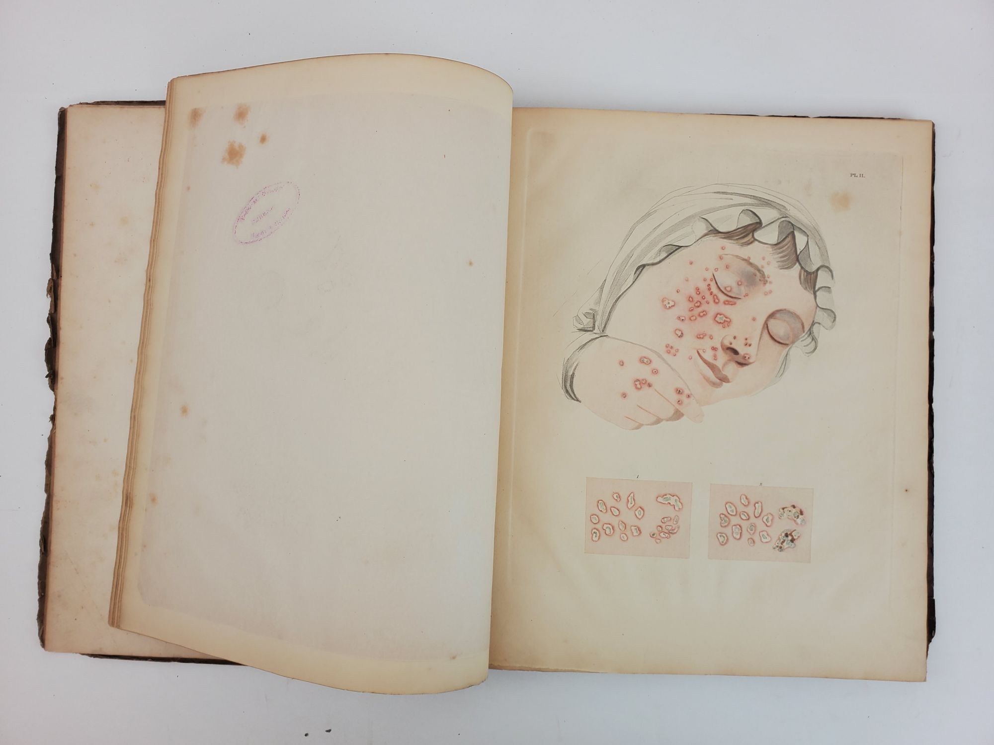 Smallpox Innoculation Boston DESCRIPTION OF THE DISTINCT, CONFLUENT, AND INOCULATED SMALL POX ...