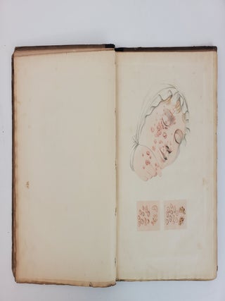 DESCRIPTION OF THE DISTINCT, CONFLUENT, AND INOCULATED SMALL POX, VARIOLOID DISEASE, COW POX, AND CHICKEN POX
