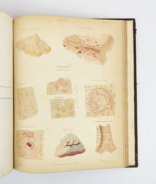A THEORETICAL AND PRACTICAL TREATISE ON THE DISEASES OF THE SKIN