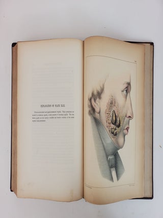 ILLUSTRATIONS OF SYPHILITIC DISEASE. TRANSLATED FROM THE FRENCH, WITH THE ADDITION OF A HISTORY OF SYPHILIS, AND A COMPLETE BIBLIOGRAPHY AND FORMULARY OF REMEDIES. WITH FIFTY LARGE QUARTO PLATES, COMPRISING 117 BEAUTIFULLY COLORED ILLUSTRATIONS