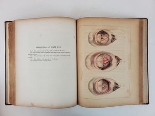 ILLUSTRATIONS OF SYPHILITIC DISEASE WITH THE ADDITION OF A HISTORY OF SYPHILIS, AND A COMPLETE BIBLIOGRAPHY AND FORMULARY OF REMEDIES. WITH FIFTY LARGE QUARTO PLATES, COMPRISING ONE HUNDRED AND SEVENTEEN BEAUTIFULLY COLORED ILLUSTRATIONS.