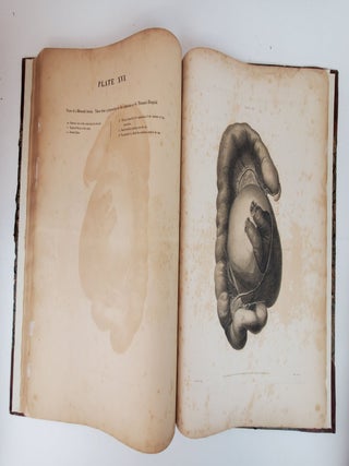 THE ANATOMY AND SURGICAL TREATMENT OF CRURAL AND UMBILICAL HERNIA, &C. &C. ILLUSTRATED BY PLATES. PART II [PART TWO ONLY]