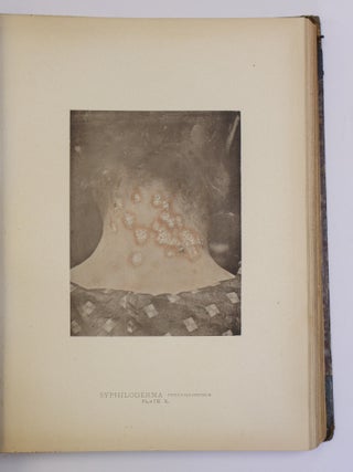 PHOTOGRAPHIC ILLUSTRATIONS OF CUTANEOUS SYPHILIS