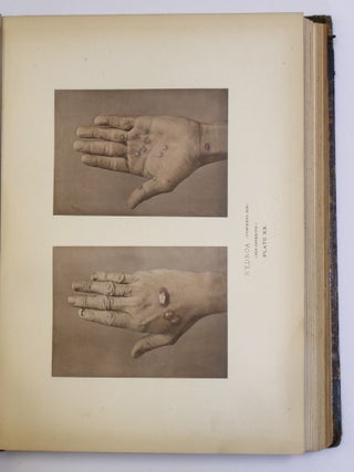 PHOTOGRAPHIC ILLUSTRATIONS OF CUTANEOUS SYPHILIS