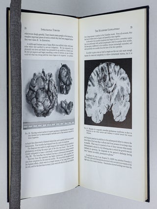 INTRACRANIAL TUMOURS